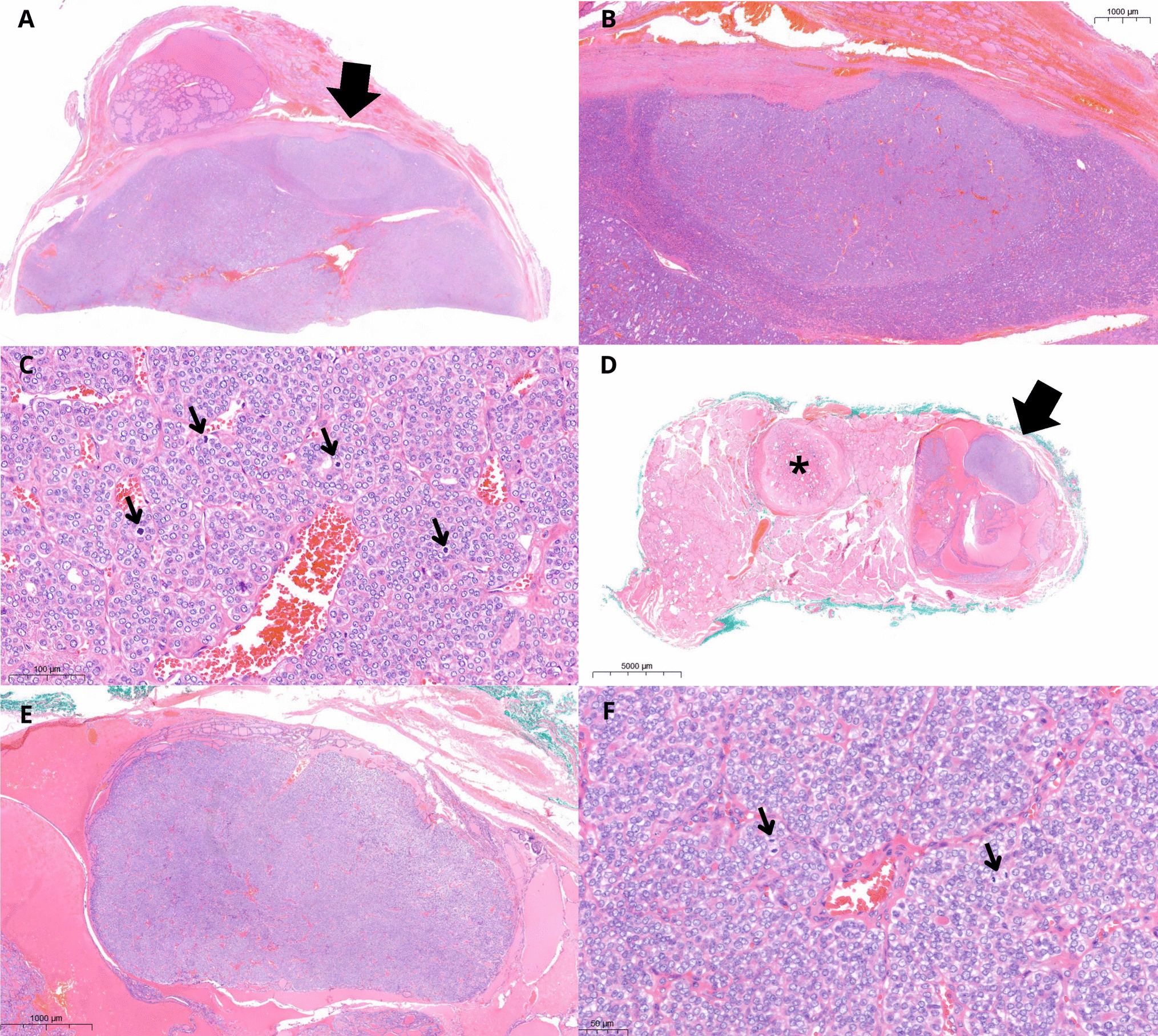 Focal High-Grade Areas with a Tumor-in-Tumor Pattern: Another Feature of Pediatric -Associated Thyroid Carcinoma?