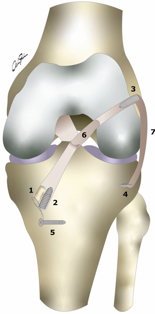 Second revision of anterior cruciate ligament reconstruction using achilles tendon allograft: a case series of 20 patients at mid-term follow-up