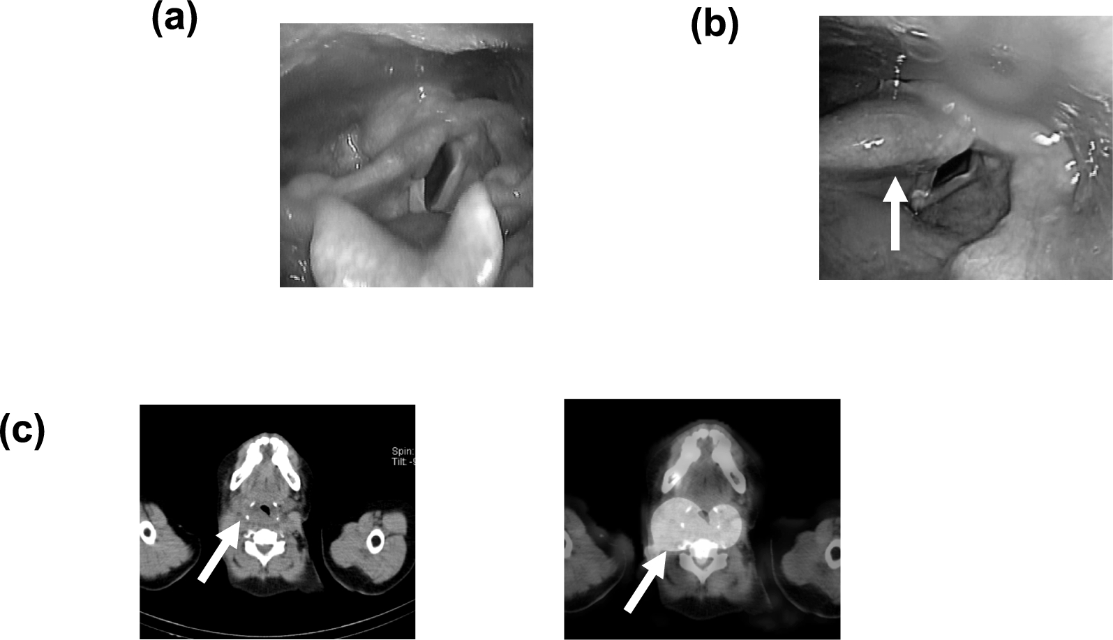Quantitative evaluation of thyroid bed accumulation in I-131 radiotherapy: a comparison of laryngeal edema and non-edematous cases