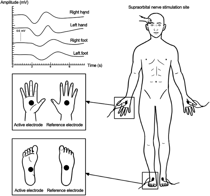 Reliability of sympathetic skin response in individuals with spinal cord injury: a supraorbital nerve stimulation approach