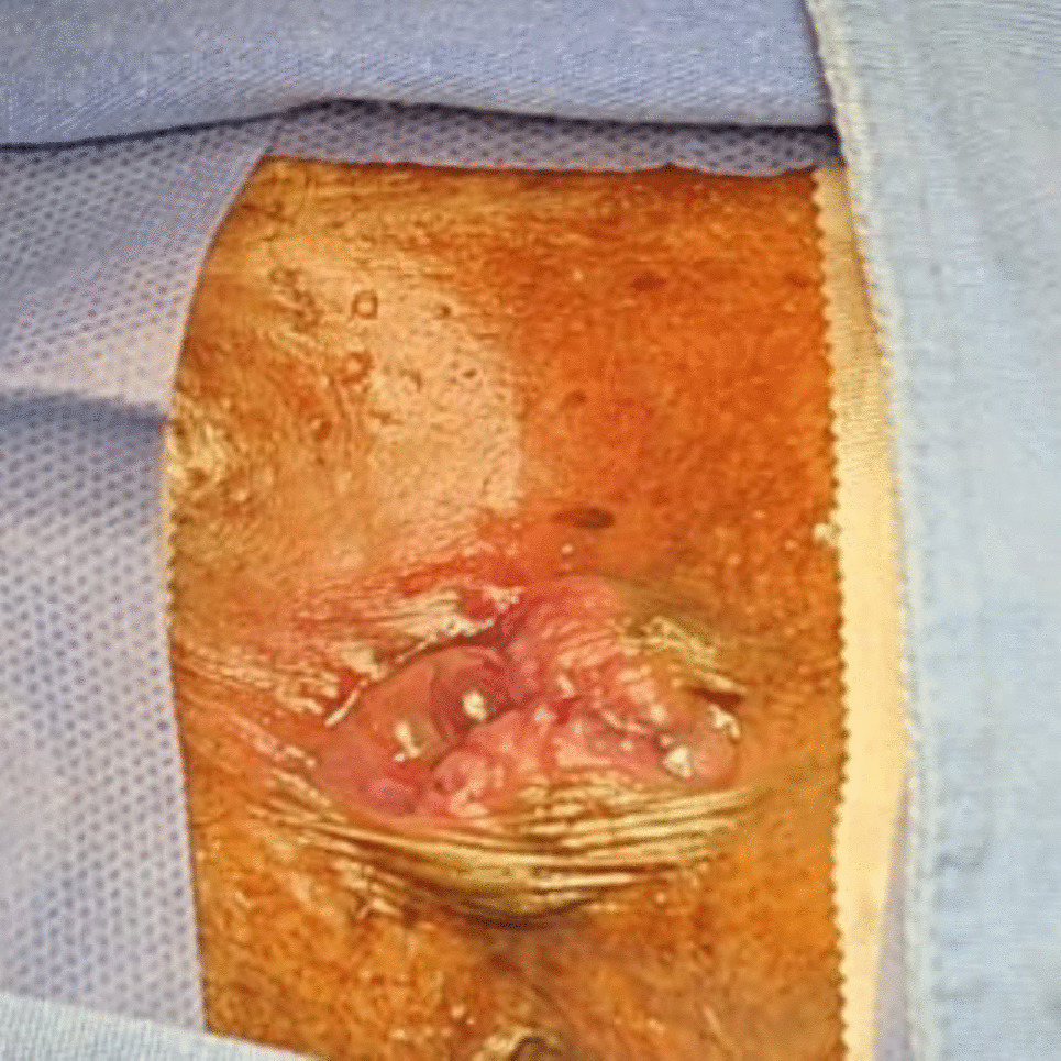 Early results of modified anorectal mucopexy and hemorrhoidoplasty with transanal suture: a 21 patient case report of “Salinas-Cabrera procedure”