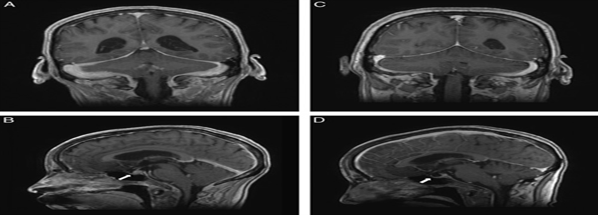 Vasculitis Presenting as Autonomic Failure