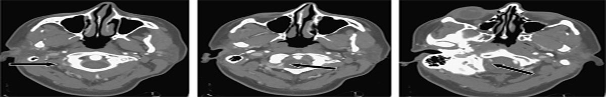 Vertebral Artery Dissection in a Woman Due to Golf: An Under Recognized Etiology