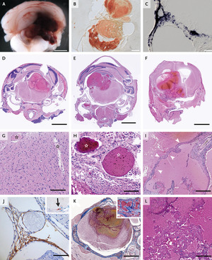 Somatic PIK3CA Mutations in Sporadic Cerebral Cavernous Malformations