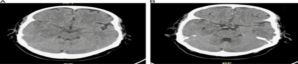 Subacute Herpes Simplex Type 1 Encephalitis: Case Report With Literature Review