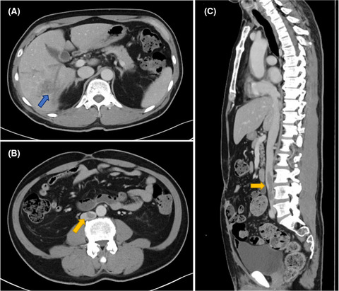 Two cases of post‐traumatic inferior vena cava thrombosis