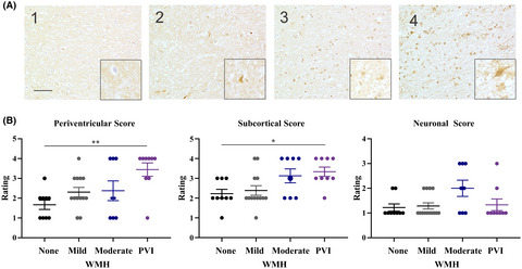 Microvessel stenosis, enlarged perivascular spaces, and fibrinogen deposition are associated with ischemic periventricular white matter hyperintensities