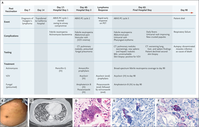 MMR Vaccine–Associated Disseminated Measles in an Immunocompromised Adolescent