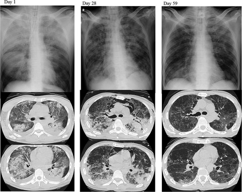 Combination therapy with levofloxacin and cefepime to treat severe respiratory infection due to Aeromonas caviae after a near‐drowning accident in river water