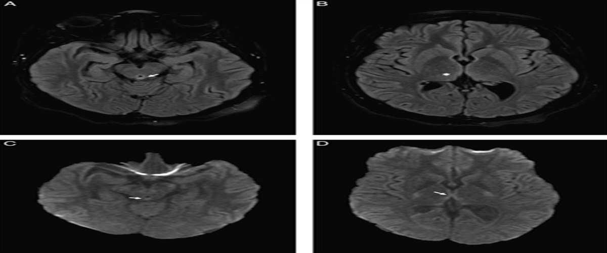 Wernicke Encephalopathy From Olfactory Dysfunction After COVID-19 Infection