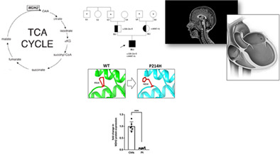 Bi‐allelic variants in MDH2: expanding the clinical phenotype