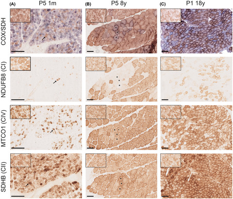 Expression pattern of mitochondrial respiratory chain enzymes in skeletal muscle of patients with mitochondrial myopathy associated with the homoplasmic m.14674T>C variant