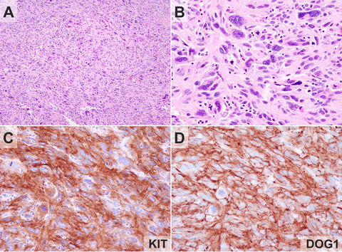 The prognostic significance of pleomorphism in gastrointestinal stromal tumours