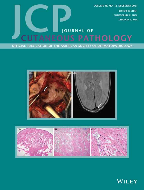 Cicatricial Pemphigoid Brunsting‐Perry Variant Masquerading as Neutrophil‐Medicated Cicatricial Alopecia