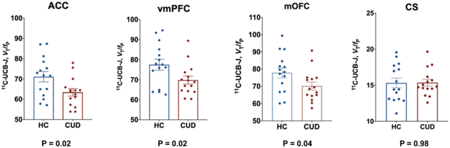 Lower prefrontal cortical synaptic vesicle binding in cocaine use disorder: An exploratory 11C‐UCB‐J positron emission tomography study in humans