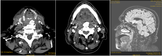 CERVICAL OSTEOPHYTES: A RARE CAUSE OF ACUTE DYSPNEA.