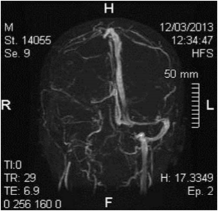 ENT Lemierre’s disease