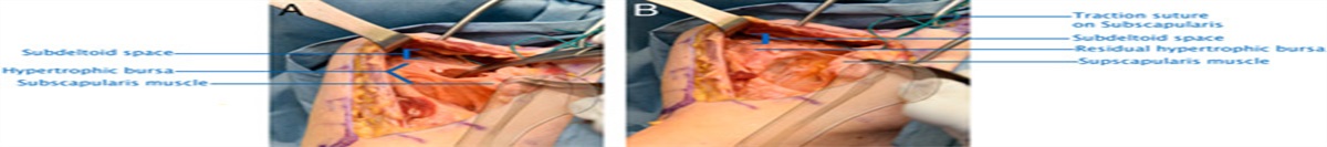 The Split Capsule Technique for Chronic Anterior Shoulder Dislocation: A Novel Surgical Technique and Case Series