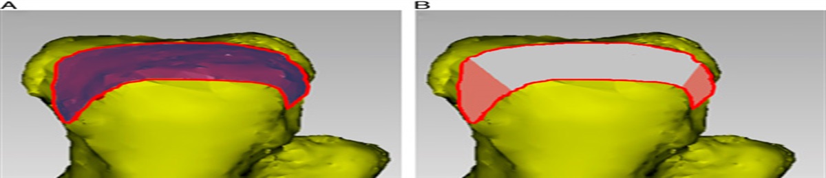 “Triple Window” Surgical Approach to the Elbow: A Hybrid Exposure