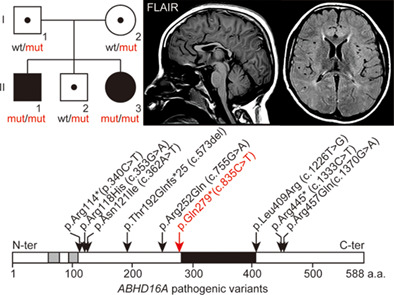 A homozygous ABHD16A variant causes a complex hereditary spastic paraplegia with developmental delay, absent speech, and characteristic face