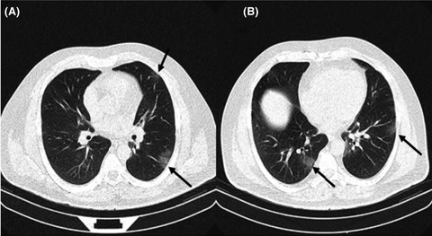 Prevalence of clinical and radiologic features in methanol‐poisoned patients with and without COVID‐19 infection