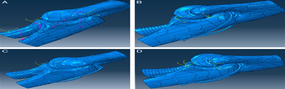 New Techniques of Olecranon Tension Band Fixation: Biomechanical Evaluation Using Finite Element Method