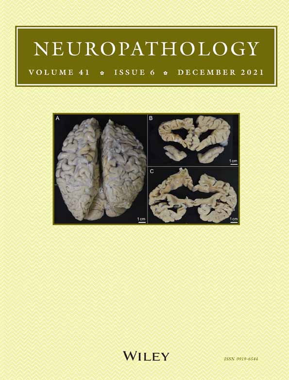 Glioblastoma and malignant melanoma: Serendipitous or anticipated association?