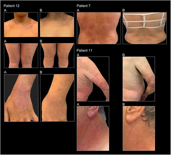 Clinical efficacy of fecal microbial transplantation treatment in adults with moderate‐to‐severe atopic dermatitis