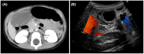 Laparoscopic cholecystectomy for gallbladder torsion in a 3‐year‐old child