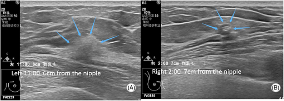 The hidden breast lesions: A case report of bilateral breast cancer