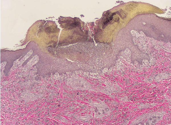 Dupilumab may be an alternative option in the treatment of acquired reactive perforating collagenosis combined with AD