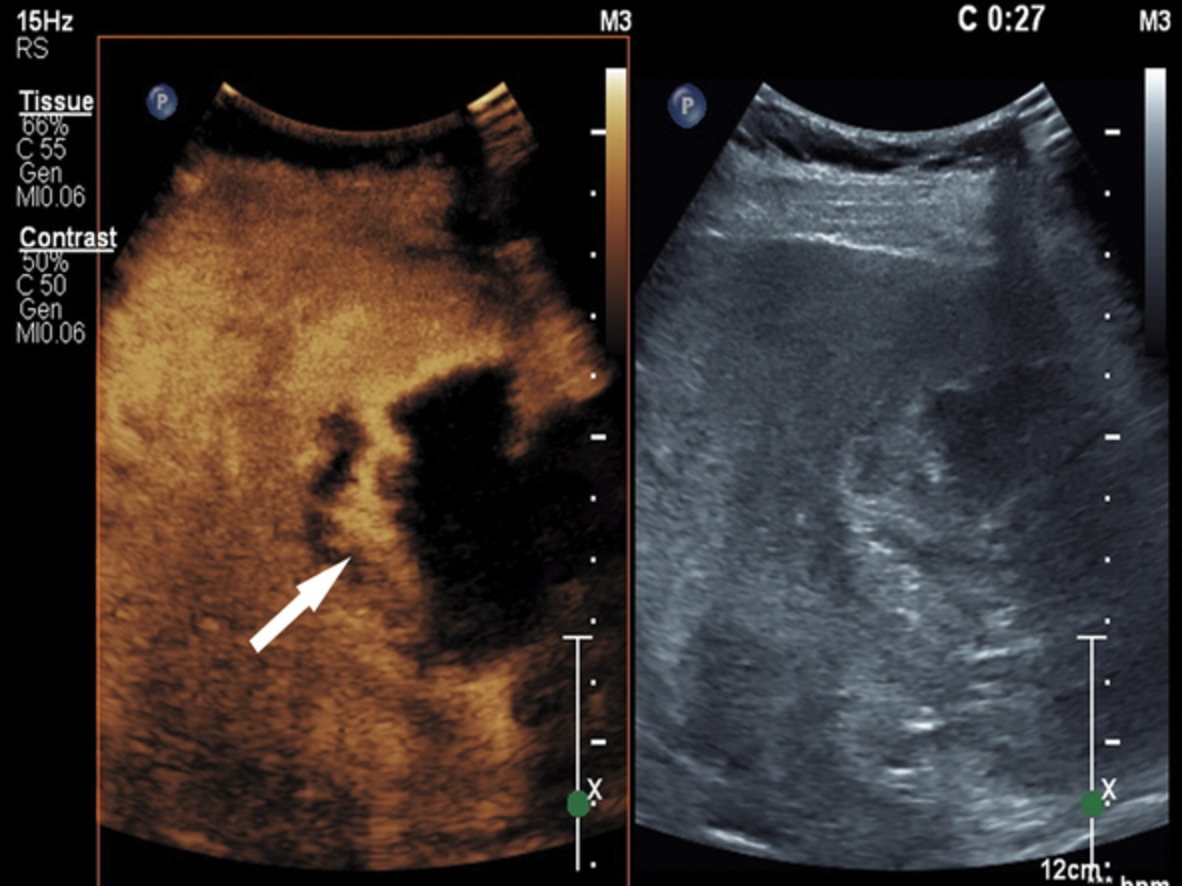 Hemorrhagic shock after contrast‐enhanced ultrasound‐guided liver biopsy: A case report of primary hepatic angiosarcoma