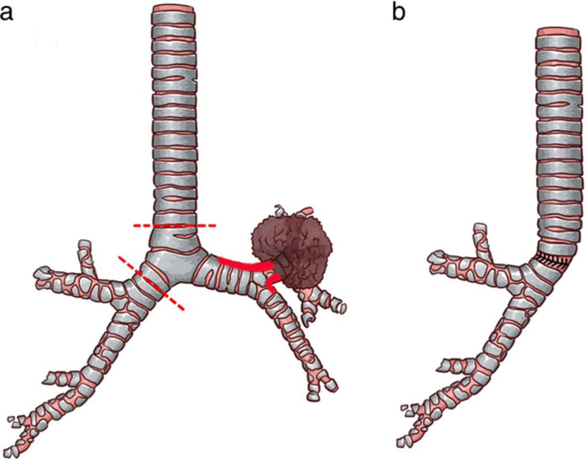 Left sleeve pneumonectomy via uniportal video‐assisted thoracoscopic approach