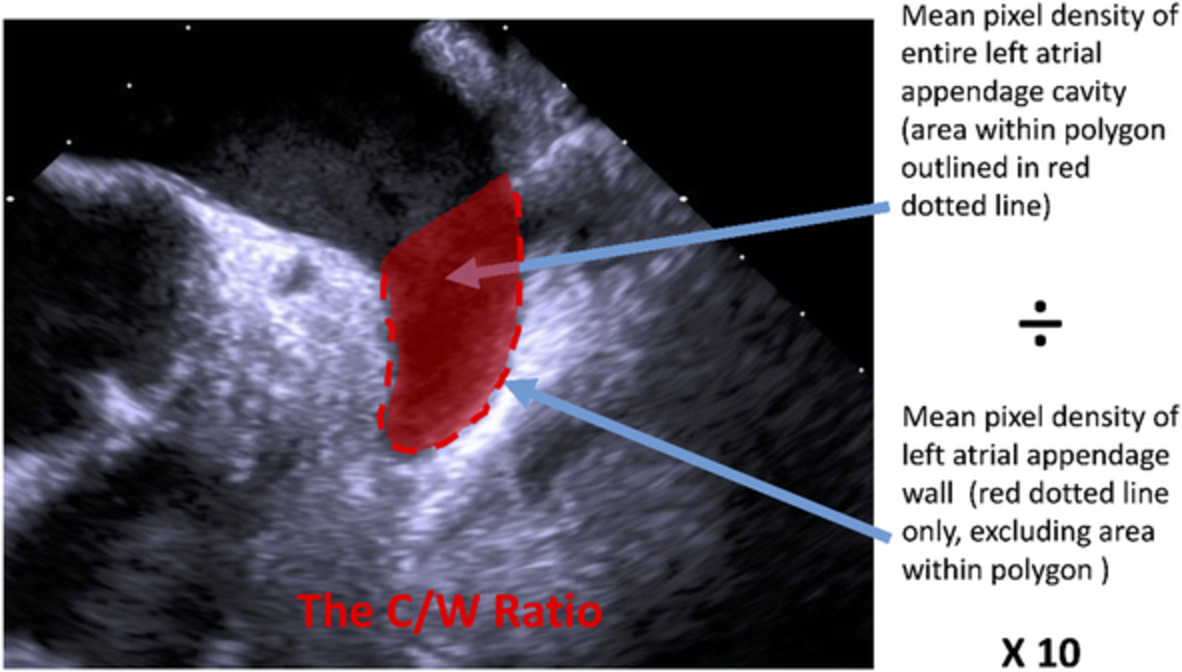 A quantitative gain‐independent assessment of the left atrial appendage as a method of thromboembolic risk stratification