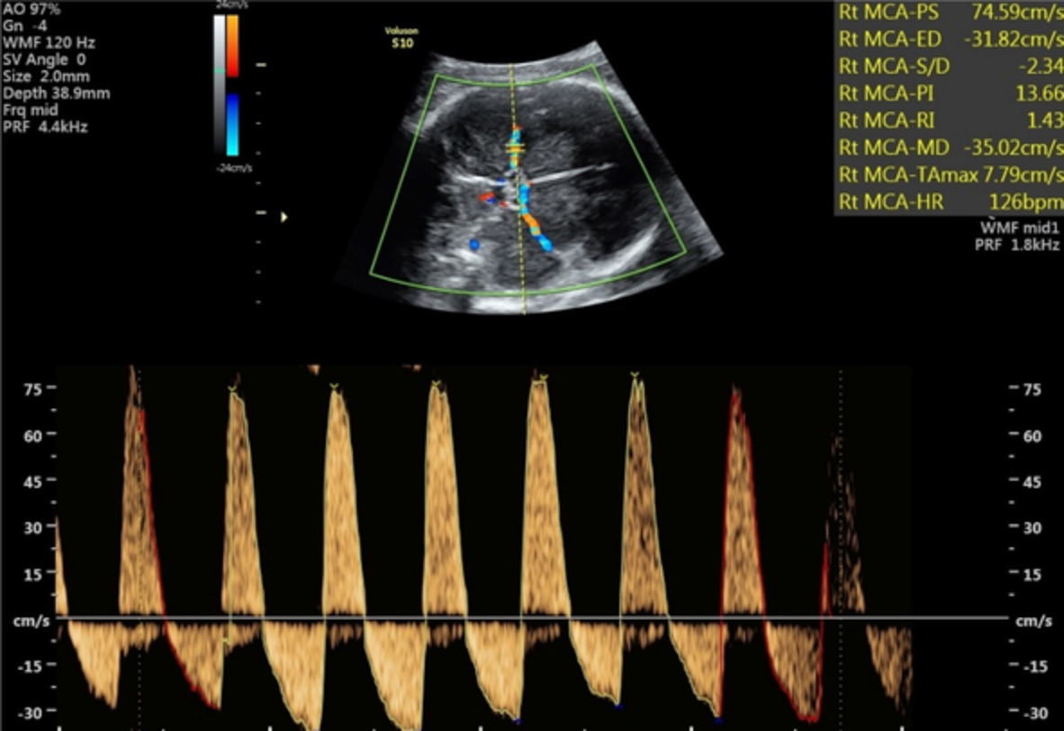 Persistent reversed end‐diastolic flow of the middle cerebral artery: A rare and concerning finding