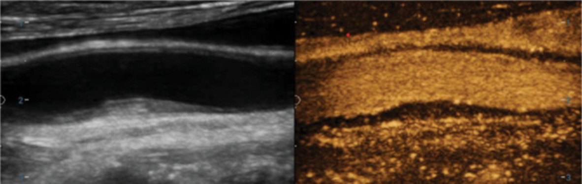 Neutrophil‐to‐lymphocyte ratio is associated with carotid intraplaque neovascularization in asymptomatic carotid stenosis patients