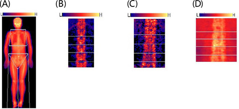 Bone mineral density, bone metabolism‐related factors, and microRNA‐218 are correlated with disease activities in Chinese ankylosing spondylitis patients