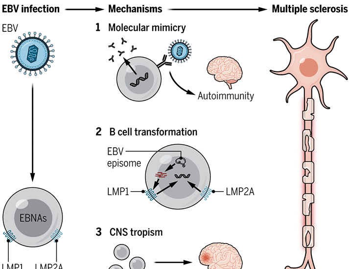 Epstein-Barr virus and multiple sclerosis