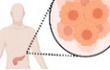 Identification of treatment‐induced vulnerabilities in pancreatic cancer patients using functional model systems