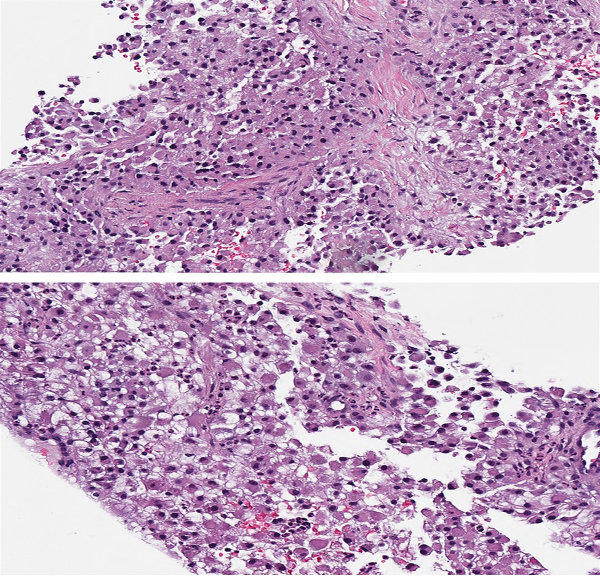 Pulmonary Oligometastasis From the Kidney Masquerading as Primary Carcinoma of the Lung