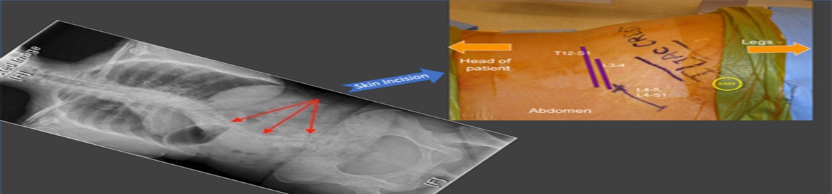 The Antepsoas (ATP) Surgical Corridor for Lumbar and Lumbosacral Arthrodesis: A Radiographic, Anatomic, and Surgical Investigation