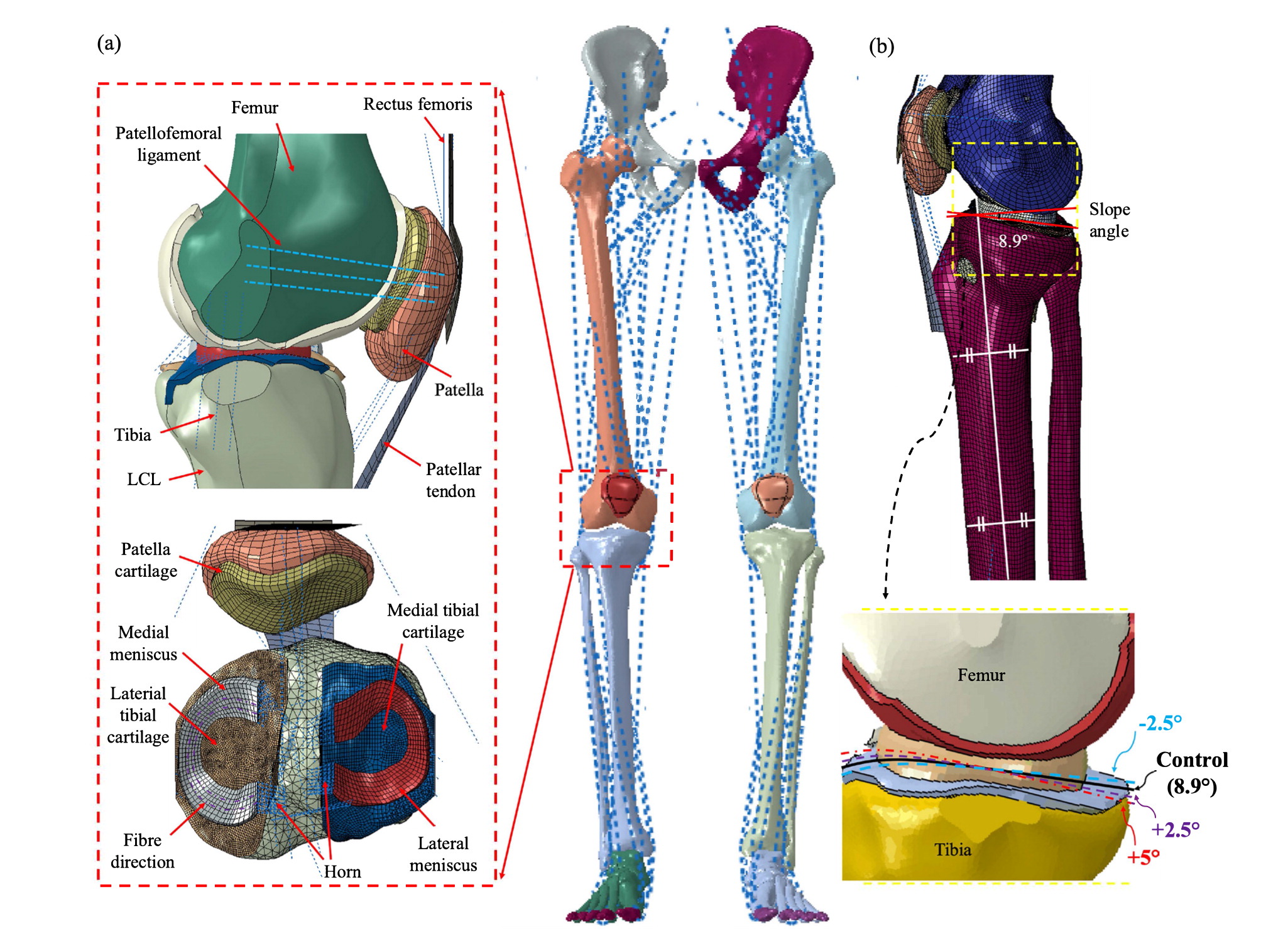 Importance of posterior tibial slope in joint kinematics with an anterior cruciate ligament-deficient knee