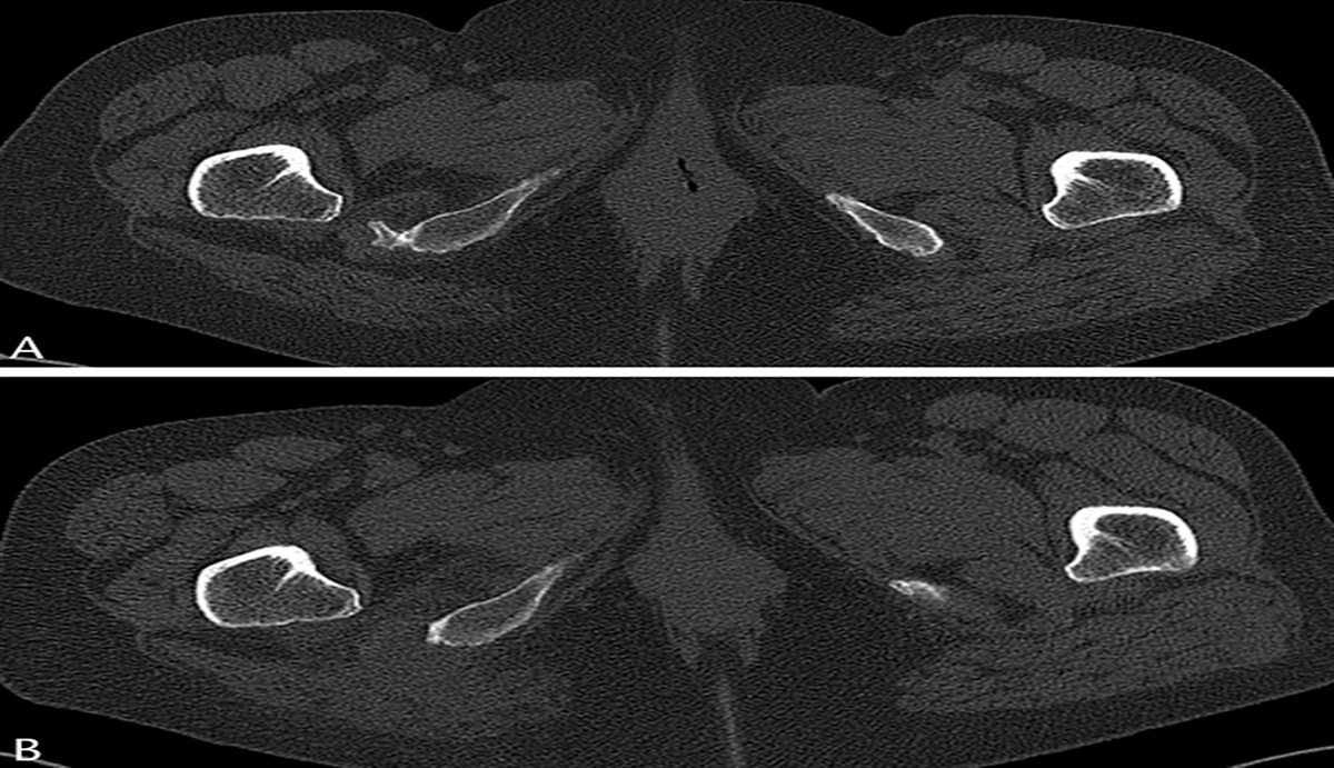 Endoscopic Ischial Tuberosity Osteophyte Resection for Treatment of Ischiofemoral Impingement: A Case Report