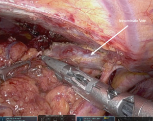 Robotic Mediastinal Surgery