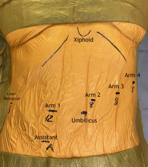 Robotic Minimally Invasive Esophagectomy