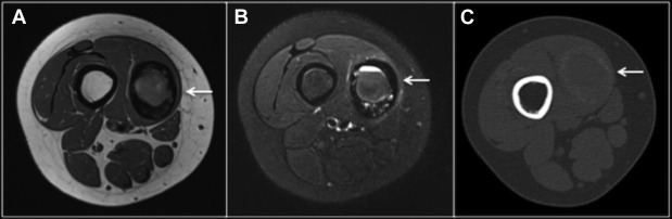 Heterotopic Ossification after Trauma