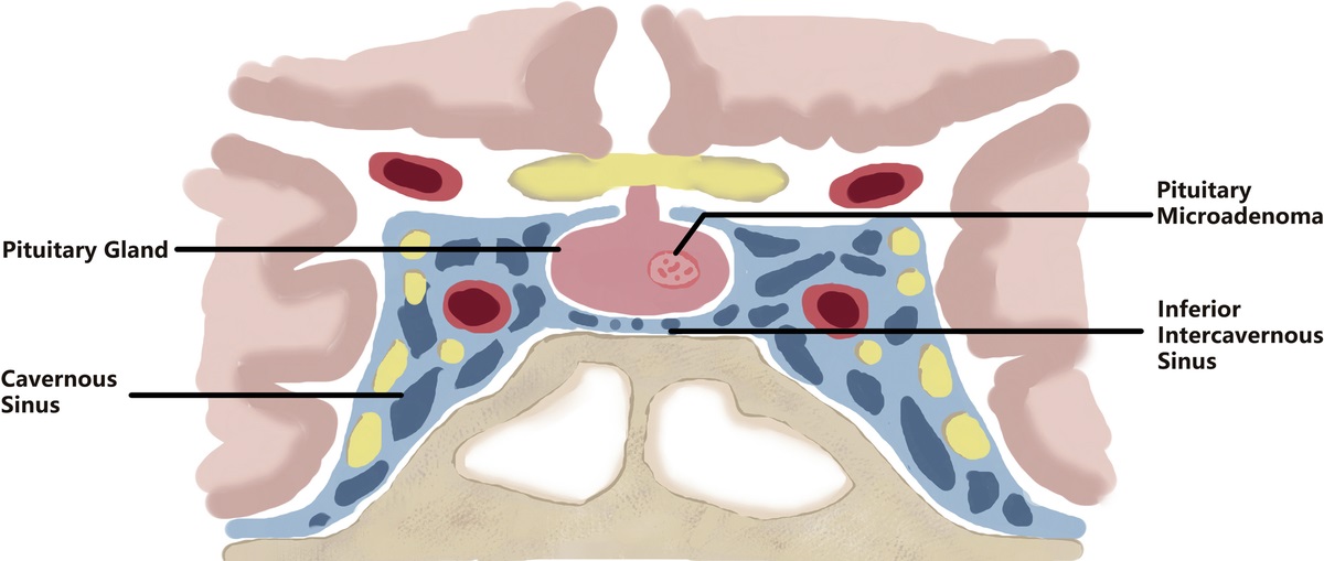 Evaluation of Inferior Intercavernous Sinus in Patients With Pituitary Microadenoma by Contrast-Enhanced SPACE Imaging