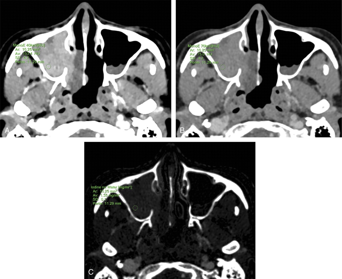 Dual-Energy Computed Tomography–Derived Iodine Density and Spectral Attenuation Analysis for Differentiation of Inverted Papilloma and Sinonasal Squamous Cell Carcinoma/Lymphoma