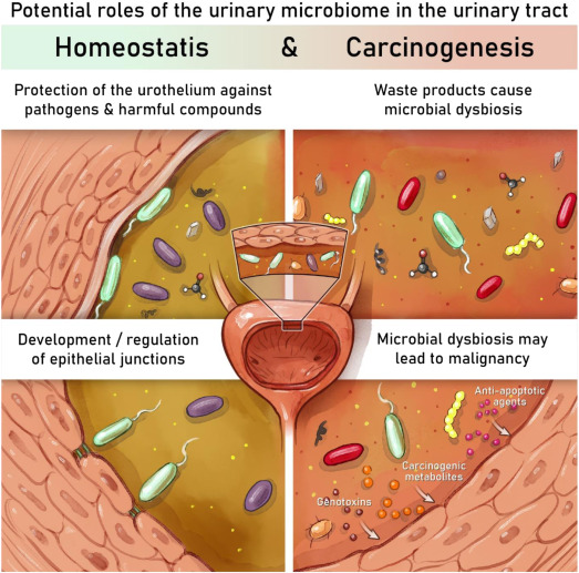 The Association Between the Urinary Microbiome and Bladder Cancer