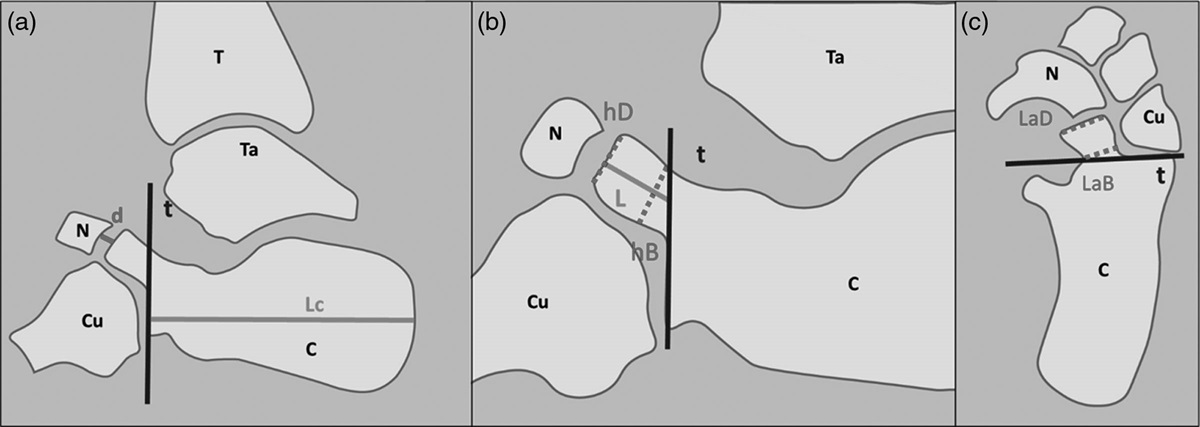 Anatomical characterization of the too-long anterior process of the calcaneum: a computed tomography scan analysis of 69 feet